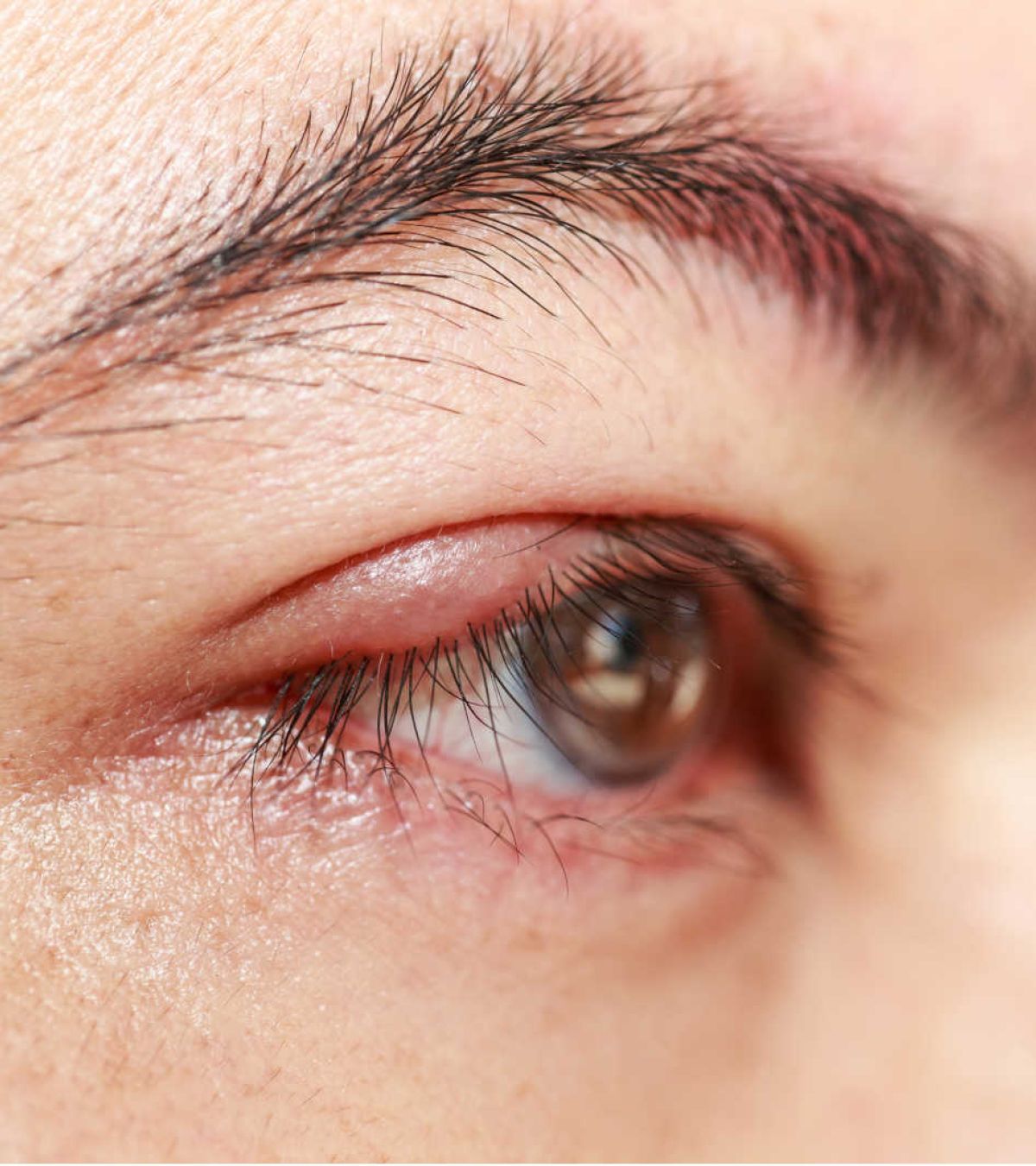 Blefaritis Therapy Houston TX